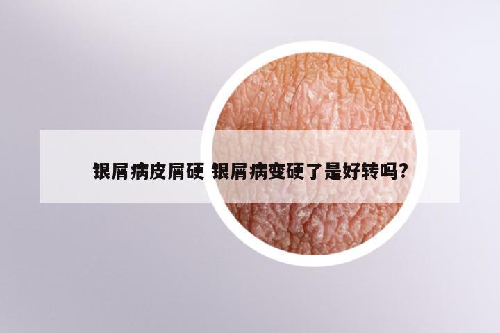 银屑病皮屑硬 银屑病变硬了是好转吗?