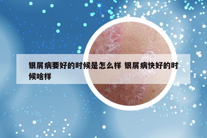 银屑病要好的时候是怎么样 银屑病快好的时候啥样