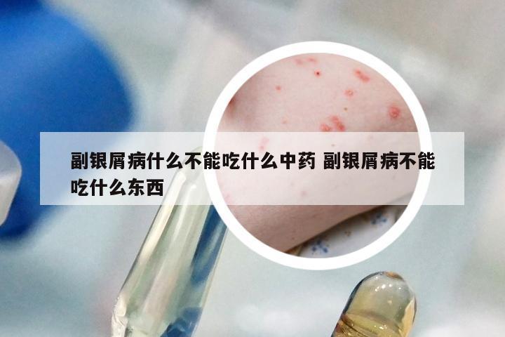 副银屑病什么不能吃什么中药 副银屑病不能吃什么东西