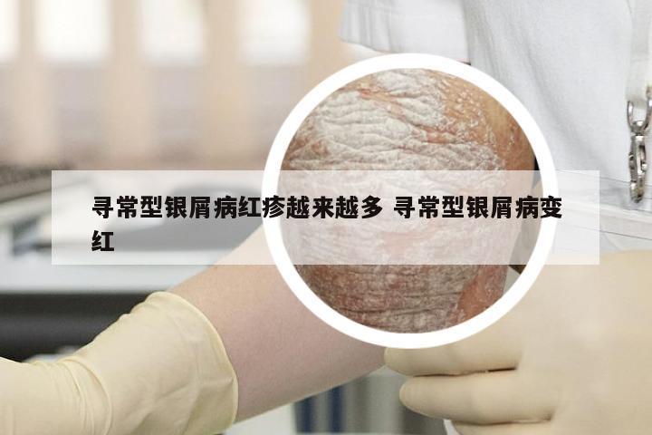 寻常型银屑病红疹越来越多 寻常型银屑病变红