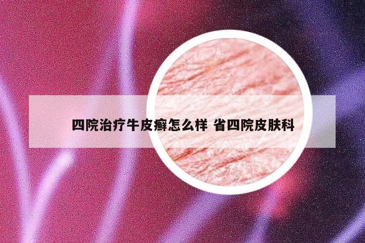 四院治疗牛皮癣怎么样 省四院皮肤科