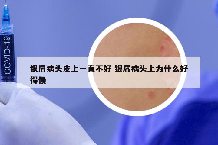 银屑病头皮上一直不好 银屑病头上为什么好得慢