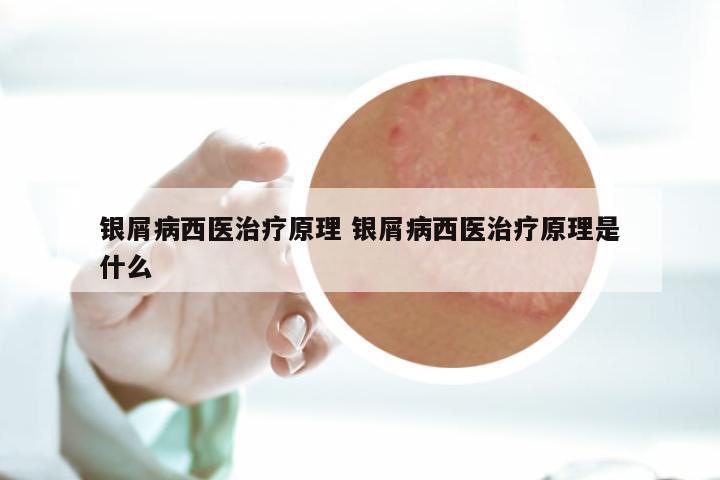 银屑病西医治疗原理 银屑病西医治疗原理是什么