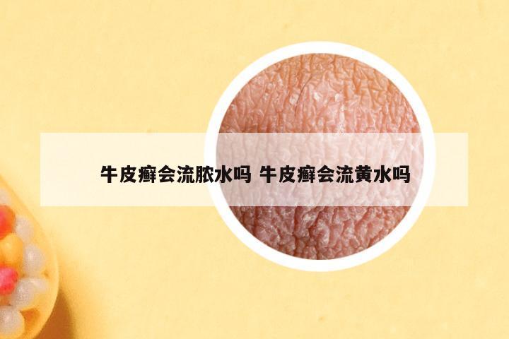 牛皮癣会流脓水吗 牛皮癣会流黄水吗