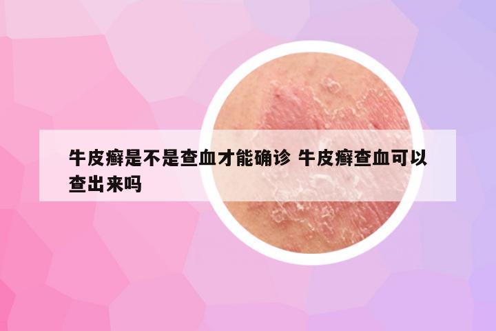牛皮癣是不是查血才能确诊 牛皮癣查血可以查出来吗