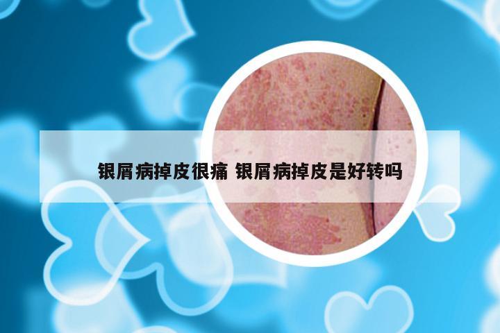 银屑病掉皮很痛 银屑病掉皮是好转吗