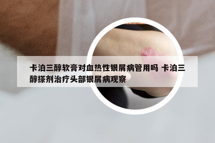 卡泊三醇软膏对血热性银屑病管用吗 卡泊三醇搽剂治疗头部银屑病观察