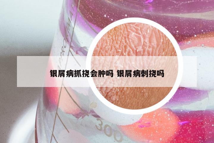 银屑病抓挠会肿吗 银屑病刺挠吗