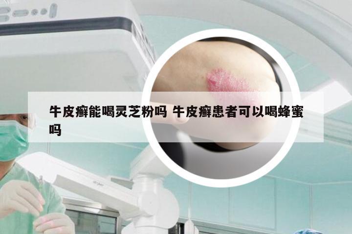 牛皮癣能喝灵芝粉吗 牛皮癣患者可以喝蜂蜜吗