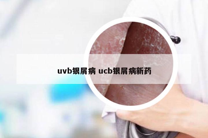 uvb银屑病 ucb银屑病新药