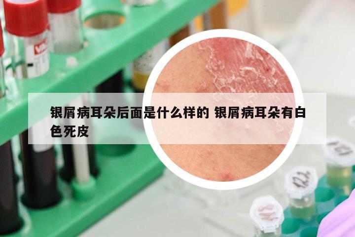 银屑病耳朵后面是什么样的 银屑病耳朵有白色死皮