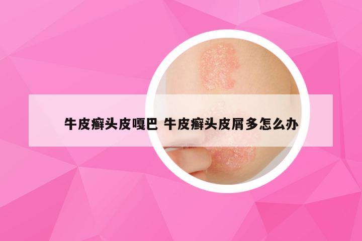 牛皮癣头皮嘎巴 牛皮癣头皮屑多怎么办