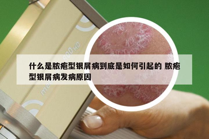 什么是脓疱型银屑病到底是如何引起的 脓疱型银屑病发病原因