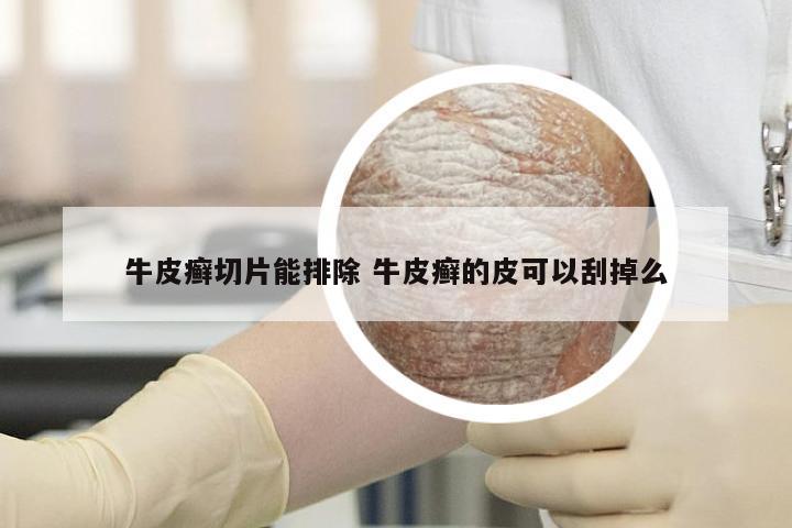 牛皮癣切片能排除 牛皮癣的皮可以刮掉么