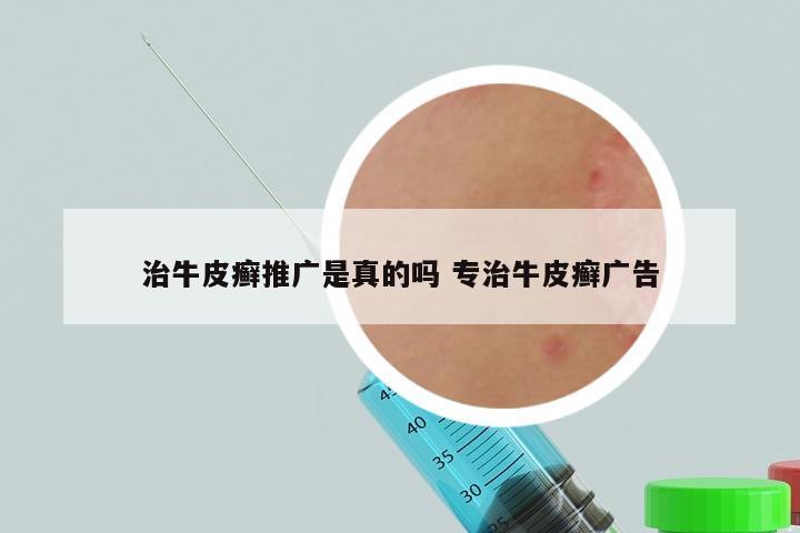 治牛皮癣推广是真的吗 专治牛皮癣广告