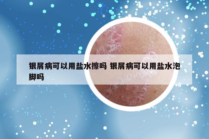 银屑病可以用盐水擦吗 银屑病可以用盐水泡脚吗