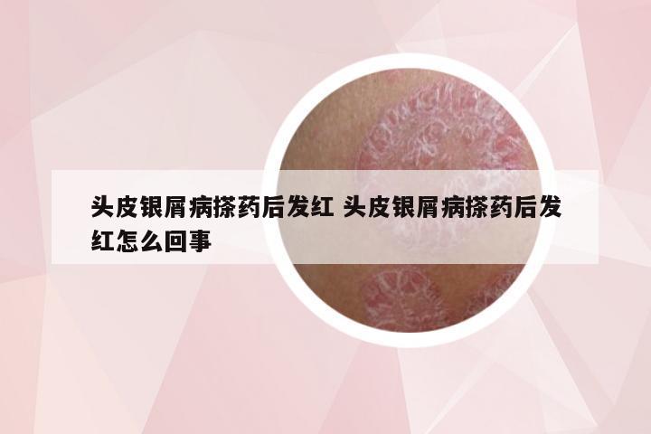 头皮银屑病搽药后发红 头皮银屑病搽药后发红怎么回事