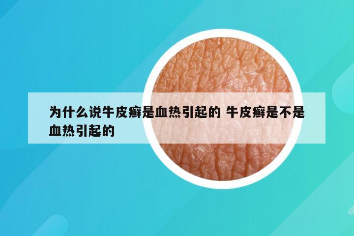 为什么说牛皮癣是血热引起的 牛皮癣是不是血热引起的