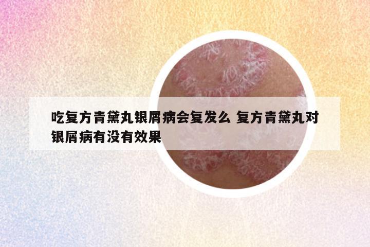 吃复方青黛丸银屑病会复发么 复方青黛丸对银屑病有没有效果