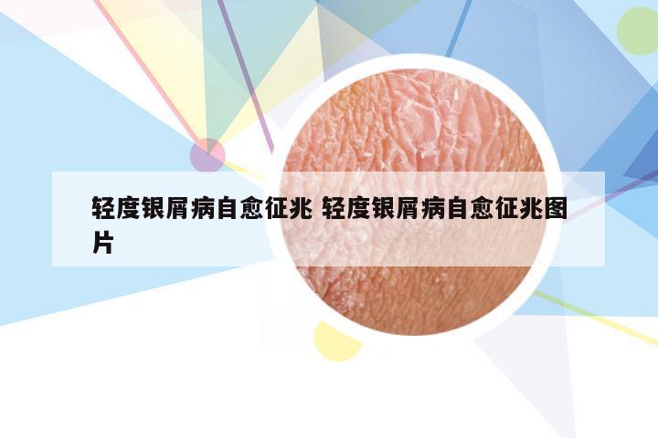 轻度银屑病自愈征兆 轻度银屑病自愈征兆图片