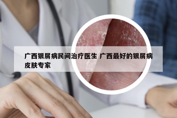 广西银屑病民间治疗医生 广西最好的银屑病皮肤专家