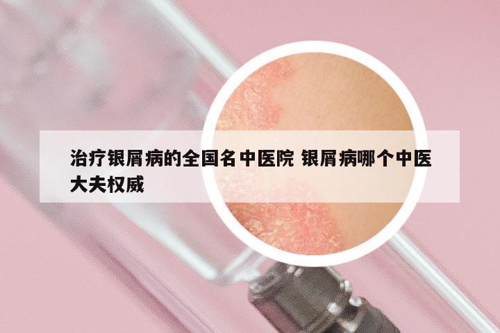 治疗银屑病的全国名中医院 银屑病哪个中医大夫权威
