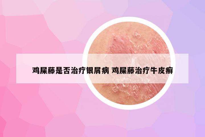 鸡屎藤是否治疗银屑病 鸡屎藤治疗牛皮癣