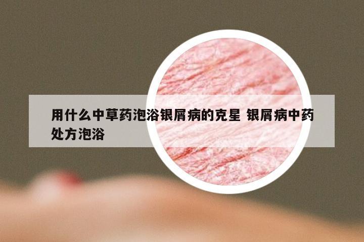 用什么中草药泡浴银屑病的克星 银屑病中药处方泡浴