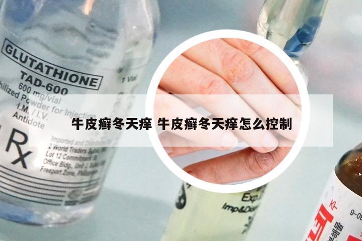 牛皮癣冬天痒 牛皮癣冬天痒怎么控制