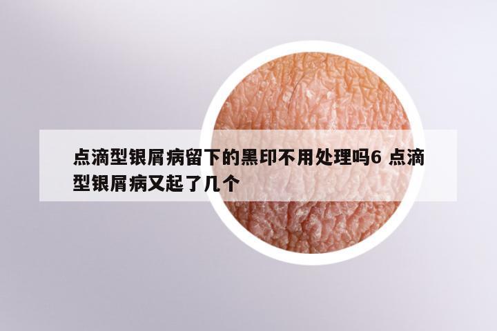 点滴型银屑病留下的黑印不用处理吗6 点滴型银屑病又起了几个