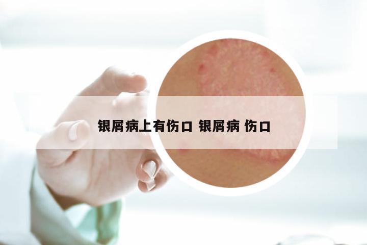 银屑病上有伤口 银屑病 伤口