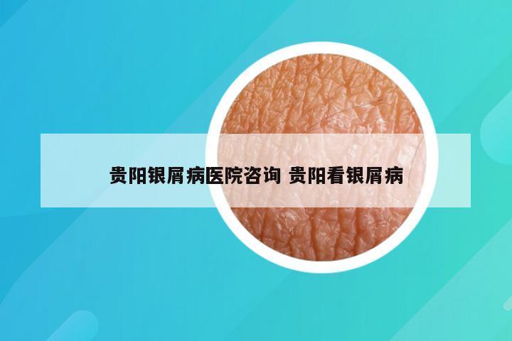 贵阳银屑病医院咨询 贵阳看银屑病