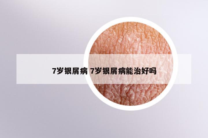7岁银屑病 7岁银屑病能治好吗