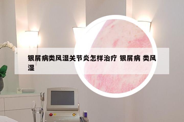 银屑病类风湿关节炎怎样治疗 银屑病 类风湿