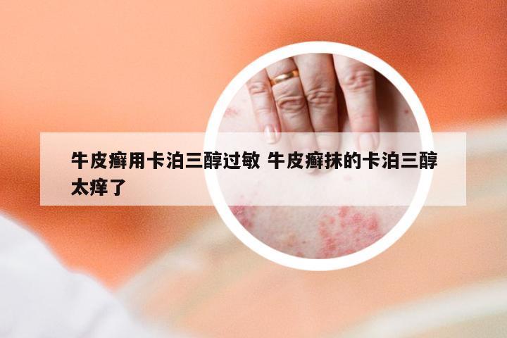 牛皮癣用卡泊三醇过敏 牛皮癣抹的卡泊三醇太痒了