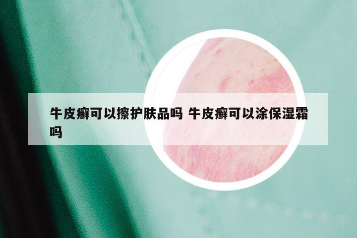 牛皮癣可以擦护肤品吗 牛皮癣可以涂保湿霜吗