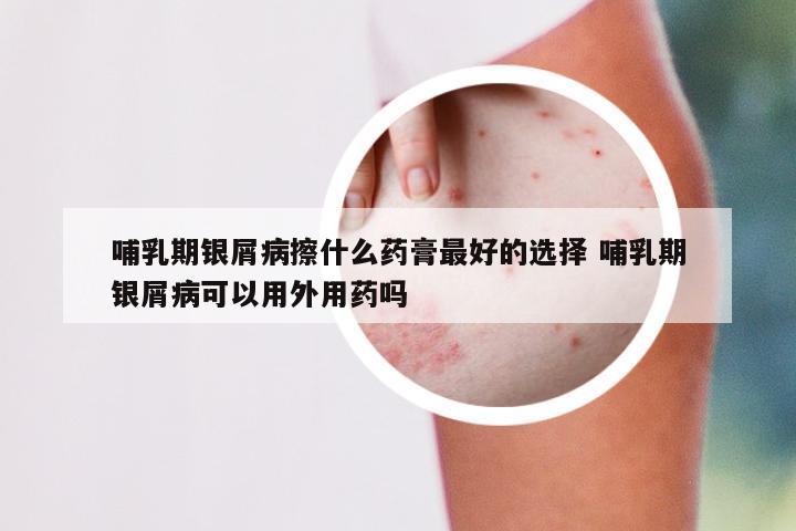 哺乳期银屑病擦什么药膏最好的选择 哺乳期银屑病可以用外用药吗