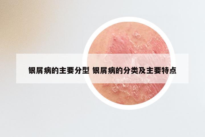 银屑病的主要分型 银屑病的分类及主要特点
