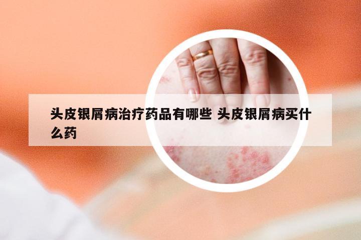 头皮银屑病治疗药品有哪些 头皮银屑病买什么药