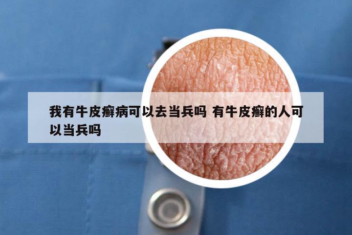 我有牛皮癣病可以去当兵吗 有牛皮癣的人可以当兵吗