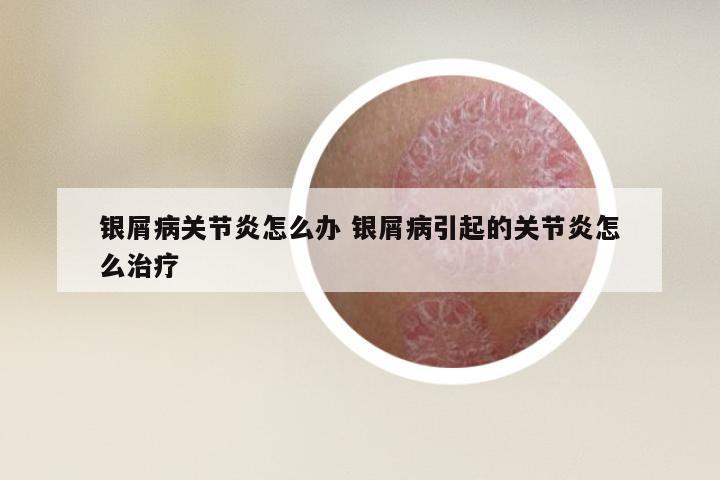 银屑病关节炎怎么办 银屑病引起的关节炎怎么治疗