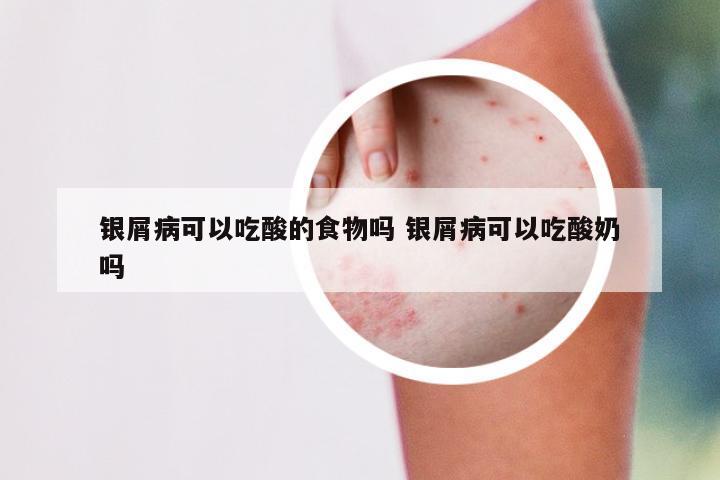 银屑病可以吃酸的食物吗 银屑病可以吃酸奶吗