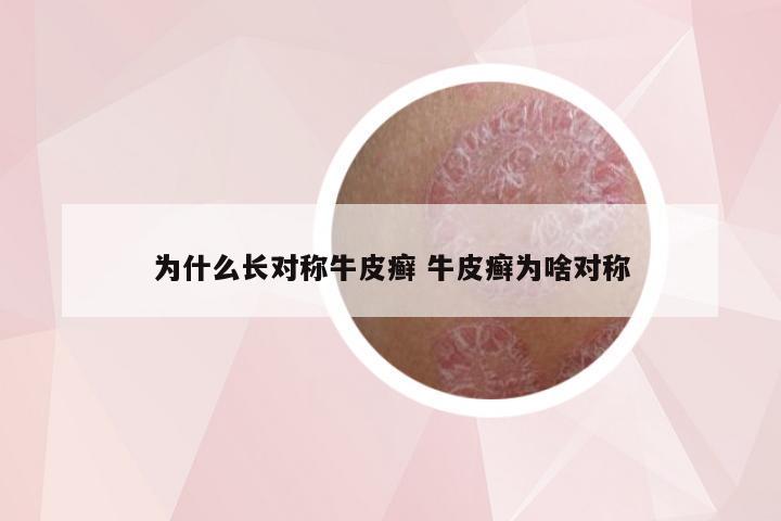 为什么长对称牛皮癣 牛皮癣为啥对称