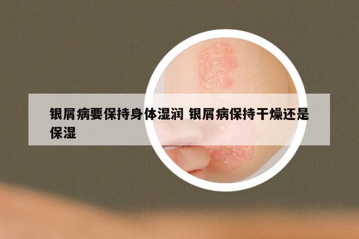 银屑病要保持身体湿润 银屑病保持干燥还是保湿