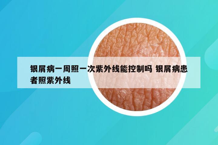 银屑病一周照一次紫外线能控制吗 银屑病患者照紫外线