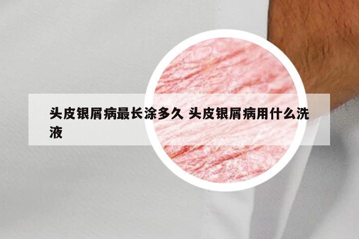 头皮银屑病最长涂多久 头皮银屑病用什么洗液