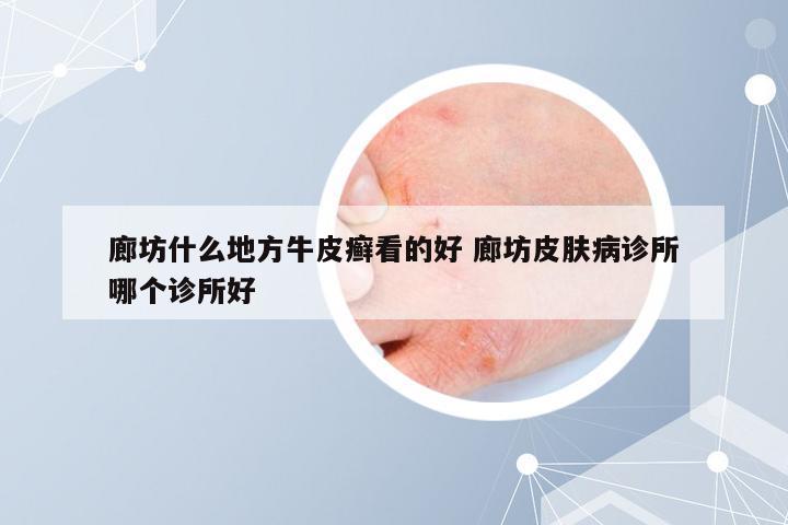 廊坊什么地方牛皮癣看的好 廊坊皮肤病诊所哪个诊所好