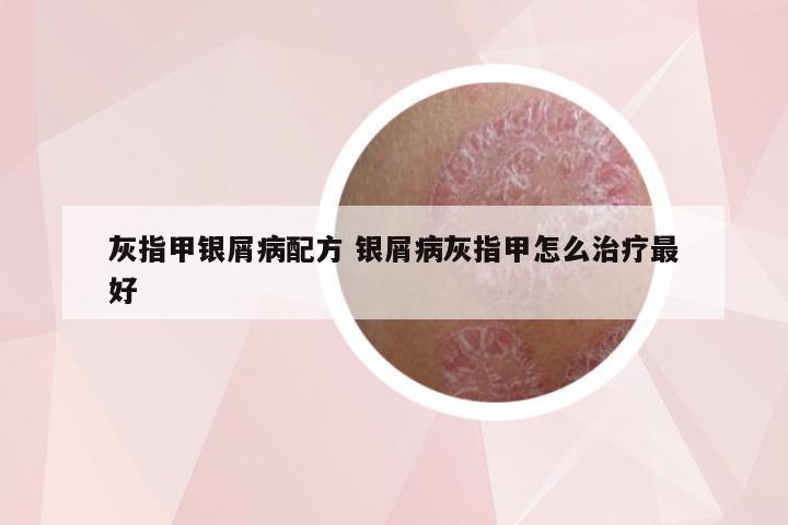 灰指甲银屑病配方 银屑病灰指甲怎么治疗最好