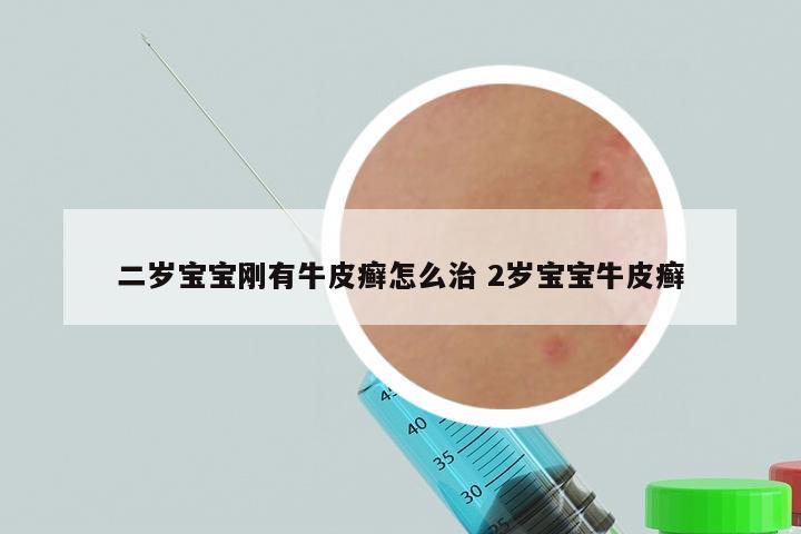 二岁宝宝刚有牛皮癣怎么治 2岁宝宝牛皮癣