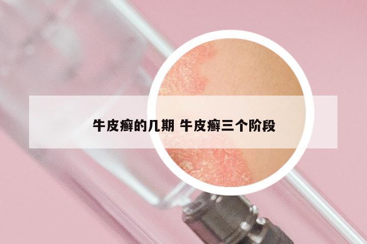 牛皮癣的几期 牛皮癣三个阶段